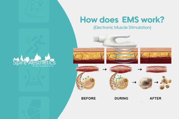 EMS treatment for post pregnancy weight loss treatment Haslemere