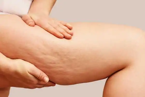 Image of woman showing leg with cellulite Haslemere