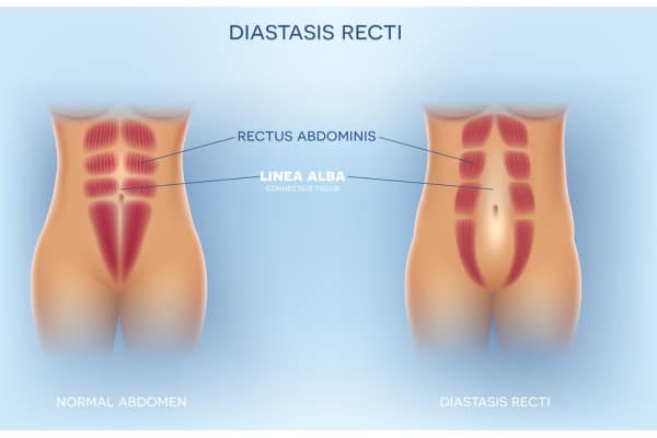 What Non-Surgical Options Are Available for Diastasis Recti Haslemere?