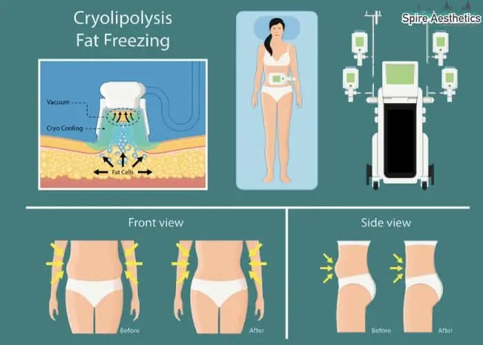 Fat freezing treatment Haslemere benefits for competitions to remove stubborn fat deposits.