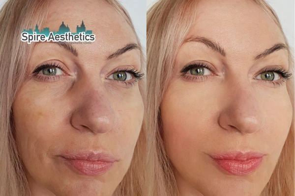 Morpheus8 Treatment Haslemere Before & After Results