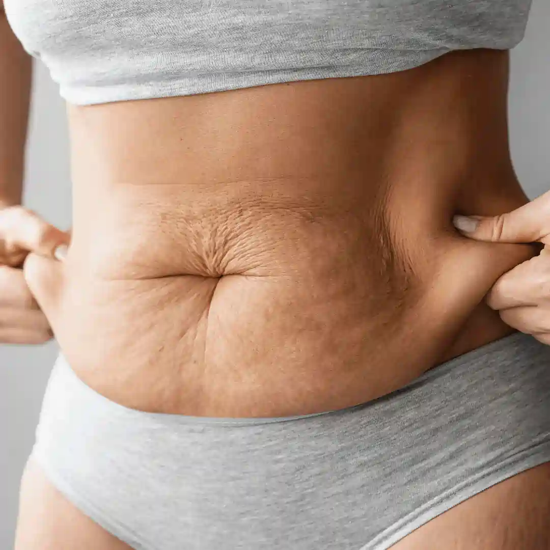 Is It Normal to Have Loose Skin After Pregnancy Haslemere?