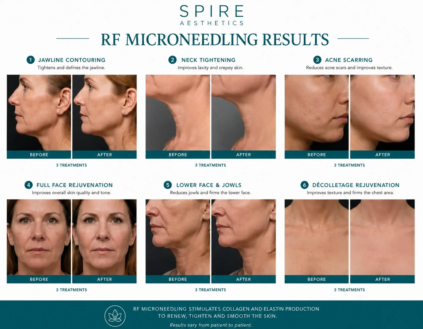 RF Microneedling Skin tightening Haslemere results