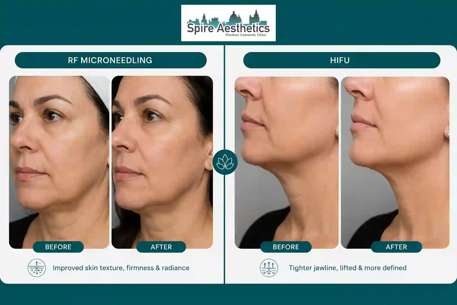 Can RF Microneedling and HIFU Be Combined Haslemere?