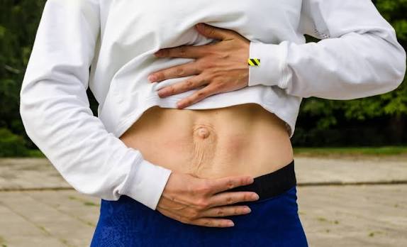 When Could Diastasis Recti Be the Missing Piece of the Puzzle Haslemere?
