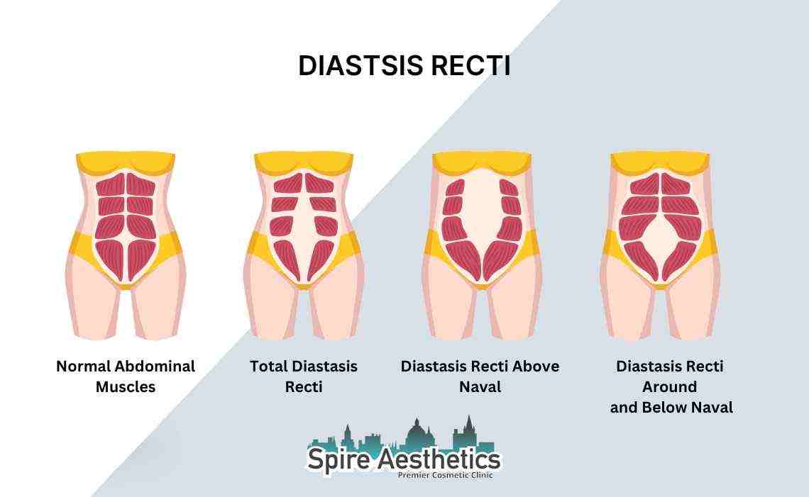 Is Non-Surgical Diastasis Recti Treatment Right for You? Common Concerns Answered Haslemere